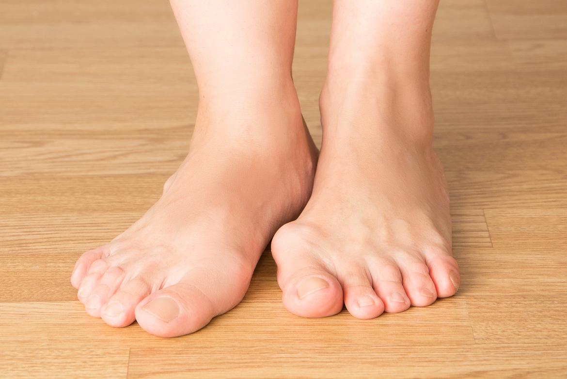 How to stop a gout attack?